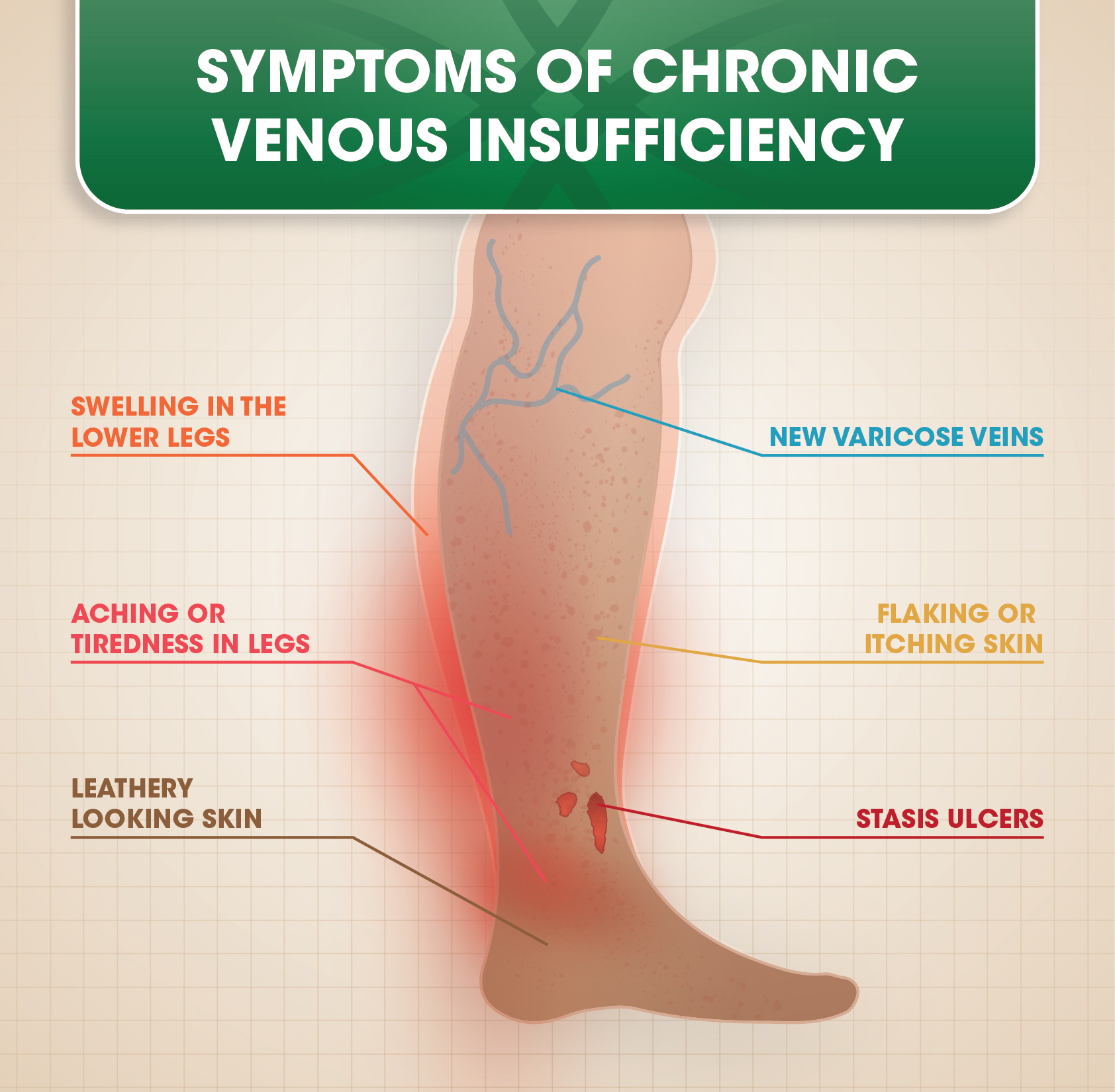 Can you reverse venous insufficiency. Cum se vindecă varicele la picioare cu ierburi
