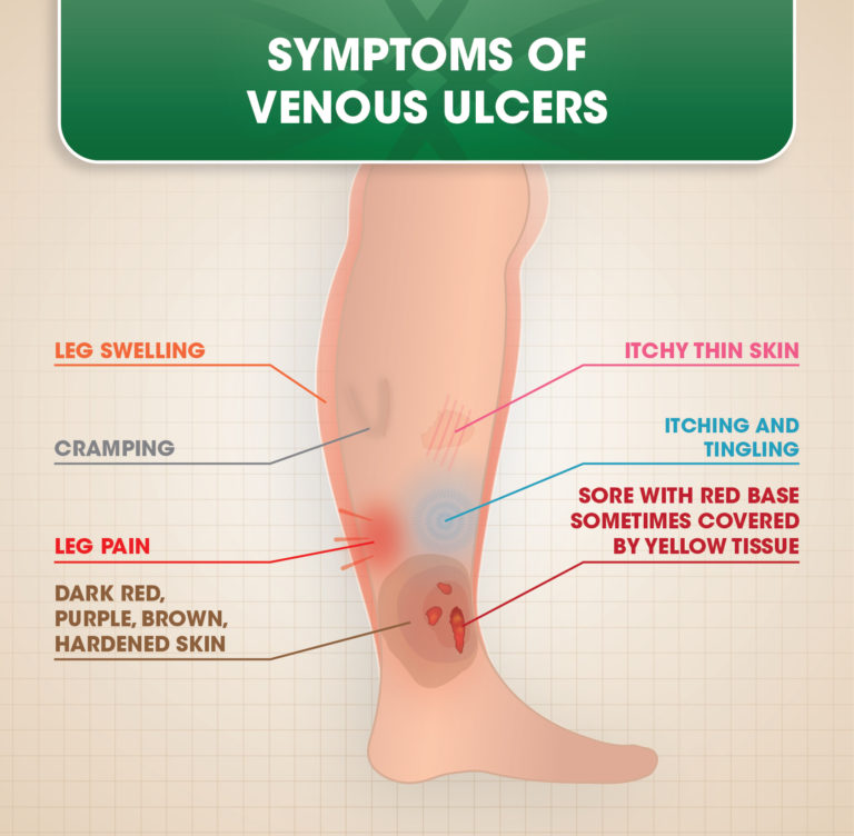 Venous Ulcers DOC Vein Management